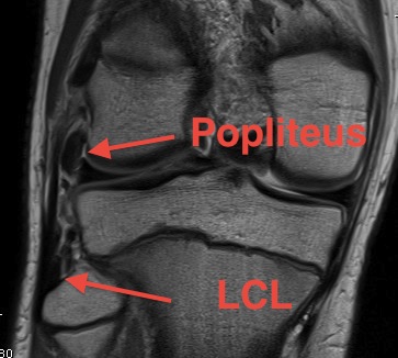 LCL Fibular Origin